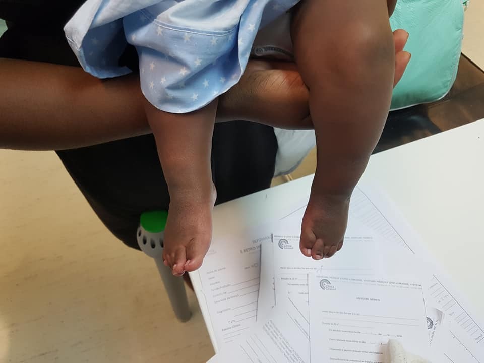 Pé Torto Congénito | Técnica da aplicação do primeiro gesso