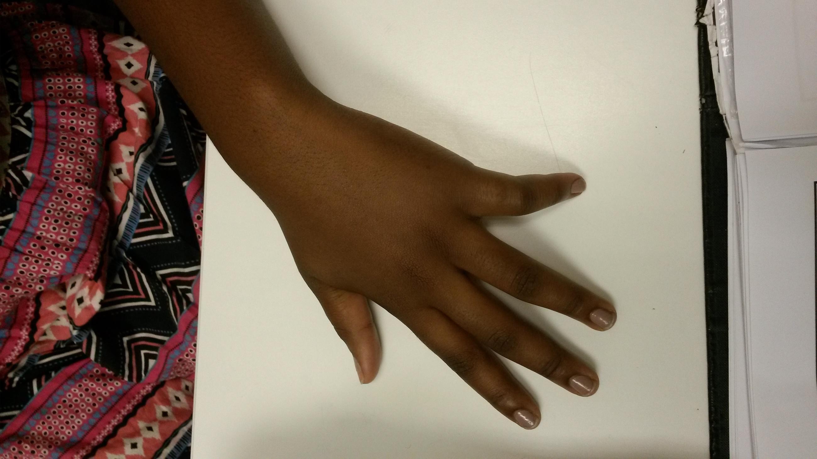 Epifisiolise do 5to dedo